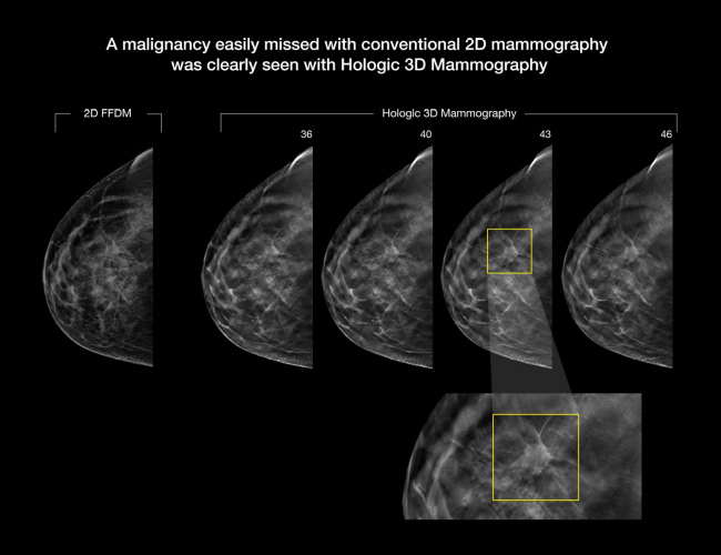 3D Tomosentez Mamografi