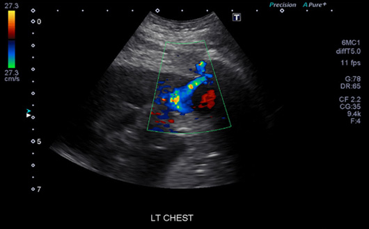 Renkli Doppler Ultrasonografisi
