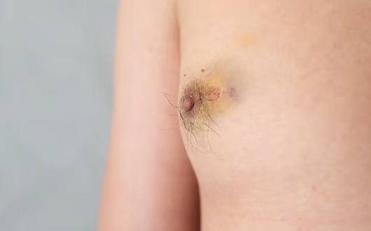 Erkek Meme Hastalıkları Nelerdir?