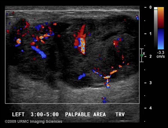 Meme Renkli Doppler Ultrasonu